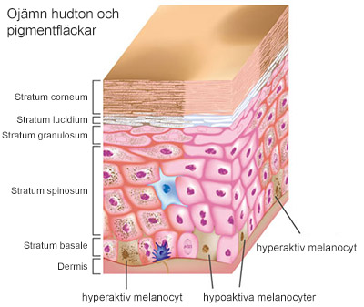 hudlager med hudceller som visar hyperpigmentering